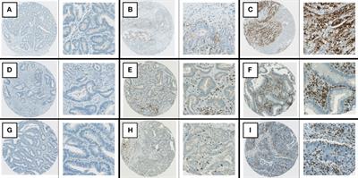 Stage-dependent prognostic shift in mismatch repair-deficient tumors: Assessing patient outcomes in stage II and III colon cancer